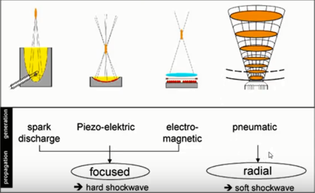 c&aacute;c loại s&oacute;ng xung k&iacute;ch